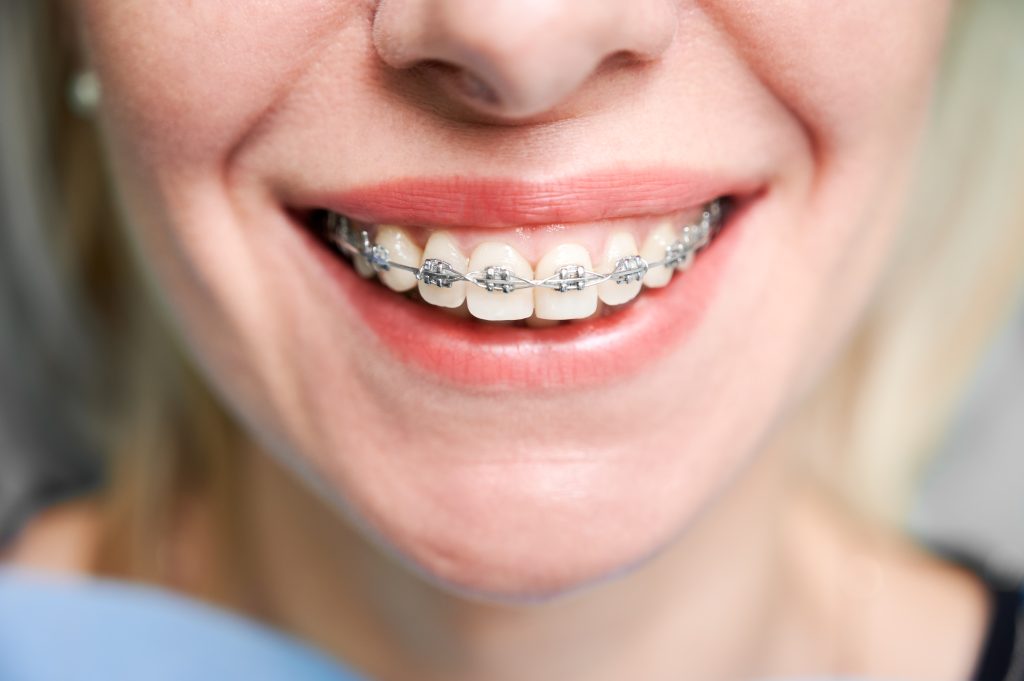 Best Age For Dental Braces