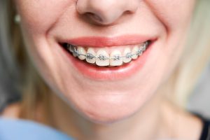 Best Age For Dental Braces